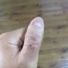 手癣的类型有哪些