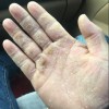 手癣都是有哪些临床症状呢