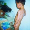 口腔溃疡艾滋病