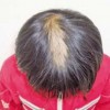 如何能够预防斑秃的发生呢