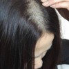 预防夏季斑秃要注意的事项