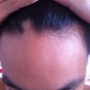 斑秃出现后的预防措施都有什么
