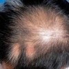 斑秃的发病原因以及护理方法