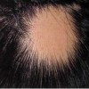 斑秃的表现症状是什么