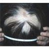 皮肤科专家解析：斑秃早期症状表现
