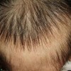 斑秃具体的早期症状都有哪些