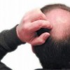 斑秃的症状病因和治疗方法