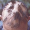 斑秃初期阶段的症状表现特点