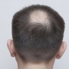 通常男性斑秃会出现哪些典型的症状