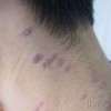 扁平苔藓预防有什么方法