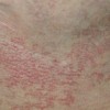 扁平苔藓有什么预防方法
