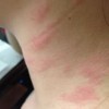 扁平苔藓的发病原因是什么