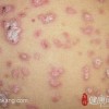 扁平苔藓病发的原因