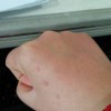 扁平疣患者的护理工作有什么呢