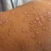 扁平疣患者护理时要注意些什么