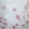 怎样鉴别扁平疣