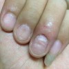 怎样治疗扁平苔癣才好呢