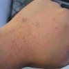 如何鉴别扁平疣的症状特点