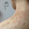 传染性软疣出现的主要症状表现