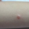 阴部传染性软疣要注意什么