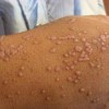 小孩子应该怎样预防扁平疣呢