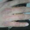 人们如何预防扁平疣情况