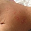 扁平疣传播途径要预防