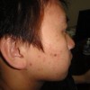 扁平疣症状的发生及预防分析