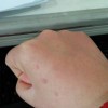 预防扁平疣要从细节做起