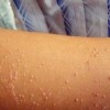 想要预防扁平疣疾病的复发需要注意哪几点？