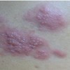 带状疱疹预防护理应注意哪些方面