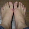 如何防治冻疮反复发作-