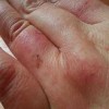 冬季该如何防止冻疮的出现