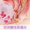 小便痛是尿道炎感染吗