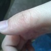 治疗汗疱疹的注意事项有哪些