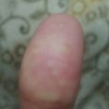 汗疱疹护理的措施是什么