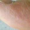 有哪些方法可以护理汗疱疹
