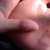 手癣与汗疱疹的区别