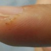 手癣与汗疱疹的区别有哪些呢