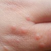 手癣与汗疱疹的区别有哪些