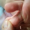 引发汗疱疹的原因都有哪些