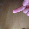 汗疱疹的发病原因是什么