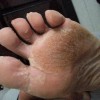 诱发汗疱疹的因素是什么