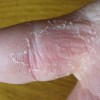 汗疱疹的症状表现与哪些疾病相似？