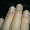 灰指甲患者在冬季应如何护理
