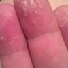 手癣与汗疱疹症状对比