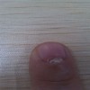 灰指甲会出现哪些常见的并发症