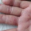 汗疱疹怎么治疗呢