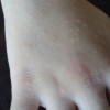 如何治疗汗疱疹