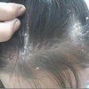 儿童头癣的预防措施有哪些